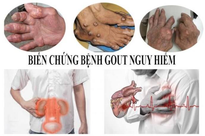 bien-chung-cua-benh-gout